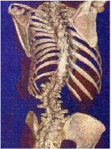 Scoliosis fusion surgery